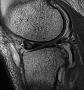 Anterior Flipped Meniscus Bucket Handle